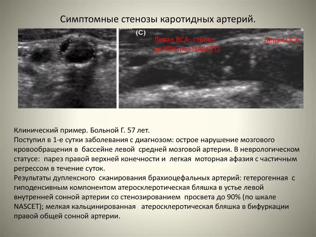 Процент стеноза сосудов. Атеросклероз сонных артерий УЗИ. Атеросклероз артерий нижних конечностей на УЗИ. Атеросклероз сосудов УЗИ.