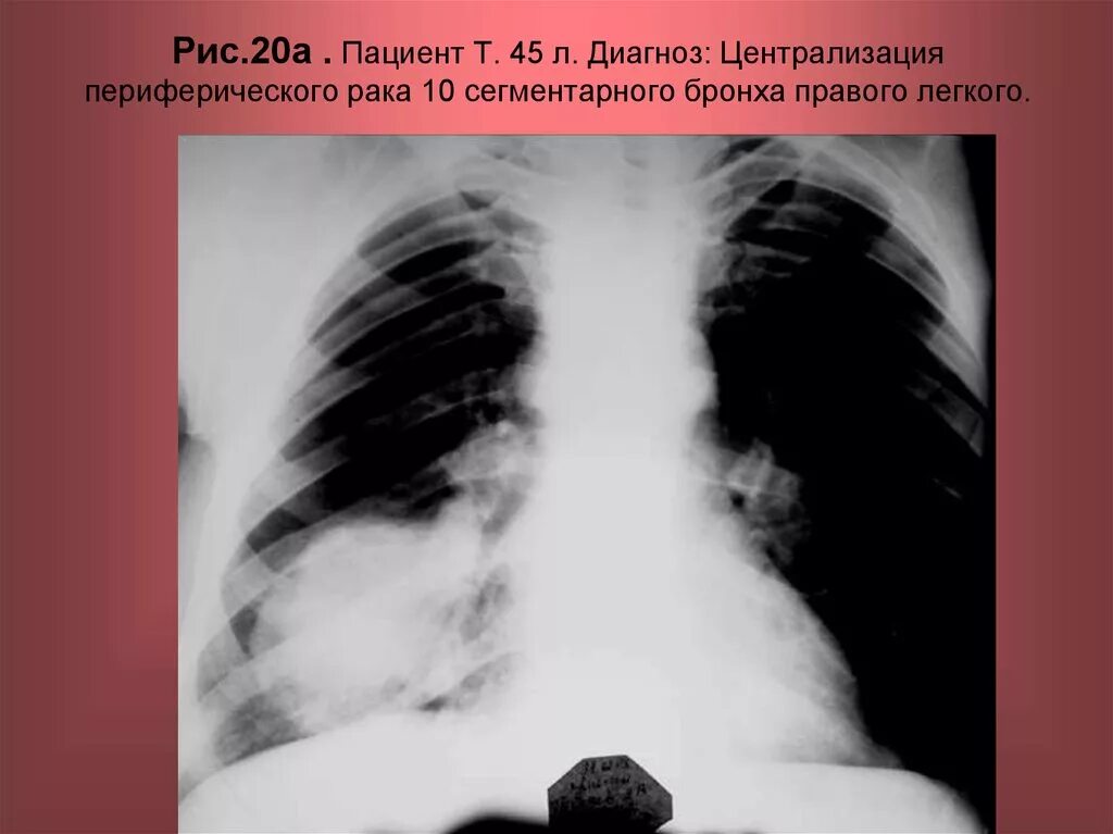 Рак нижней доли. Периферический нижней доли легкого. Периферическое образование верхней доли правого легкого. Периферическое образование левого легкого. Периферический c-r правого легкого.