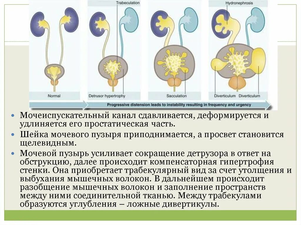 Просвет мочевого пузыря. Простатическая часть мочевого пузыря. Гипертрофия детрузора. Сокращение детрузора мочевого пузыря. Детрузор мочевого пузыря это