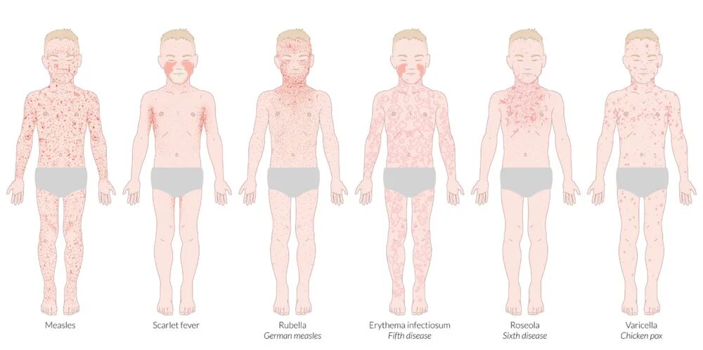 Краснуха корь скарлатина сыпь. Корь краснуха крапивница ветрянка. Корь сыпь краснуха скар. Краснуха коклюш