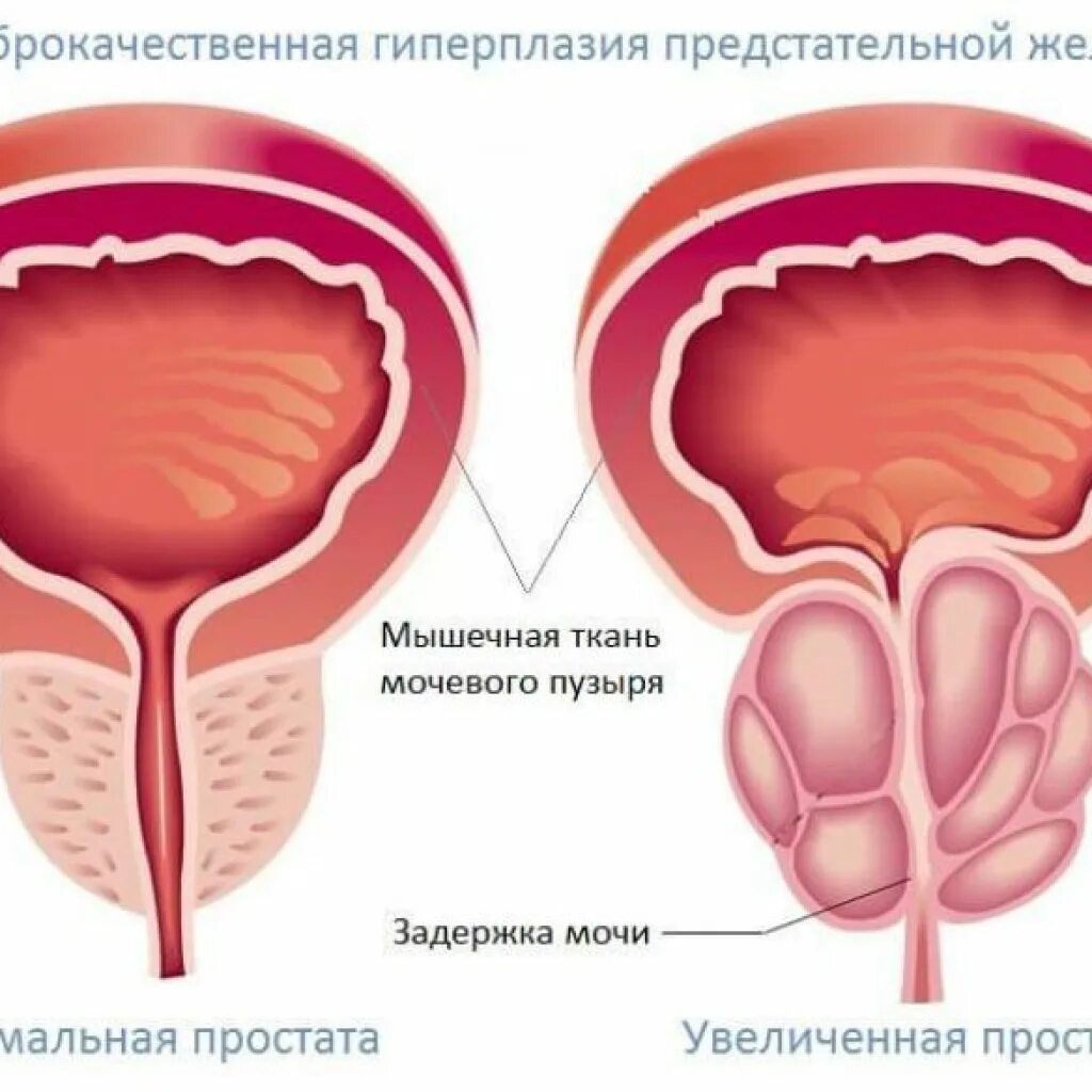 Виды простатита. Простатит начальная стадия.