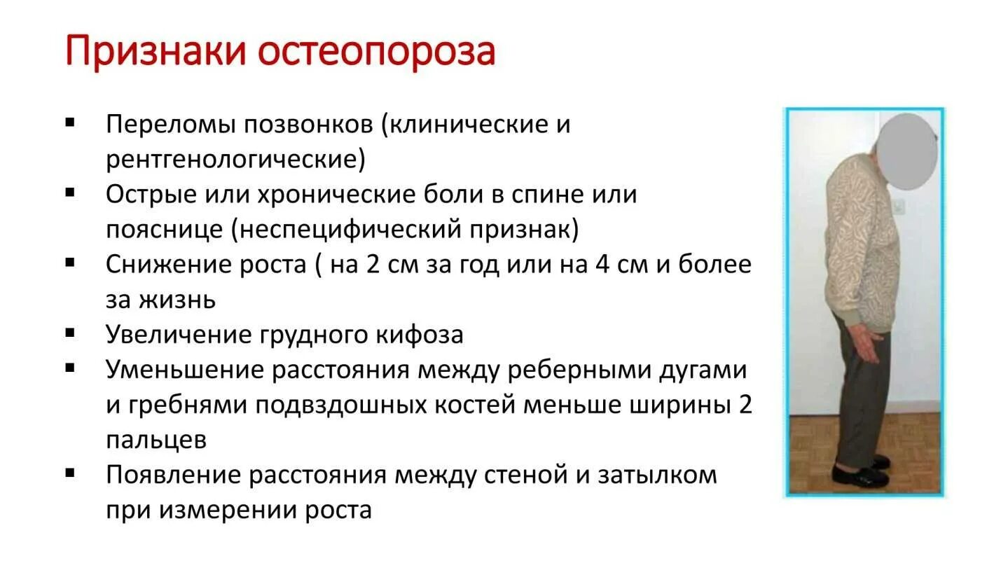 Остеопороз у женщин симптомы признаки лечение