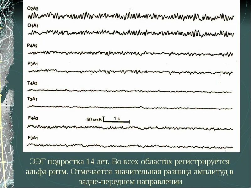 Регистрация ээг. ЭЭГ. Ритмы ЭЭГ. Амплитуда Альфа-ритма ЭЭГ. Плоская ЭЭГ.