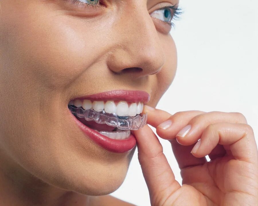 Мезиальный прикус брекеты. Элайнеры invisalign. Невидимые брекеты элайнеры. Глубокий прикус элайнерами. Элайнеры eurokappa.