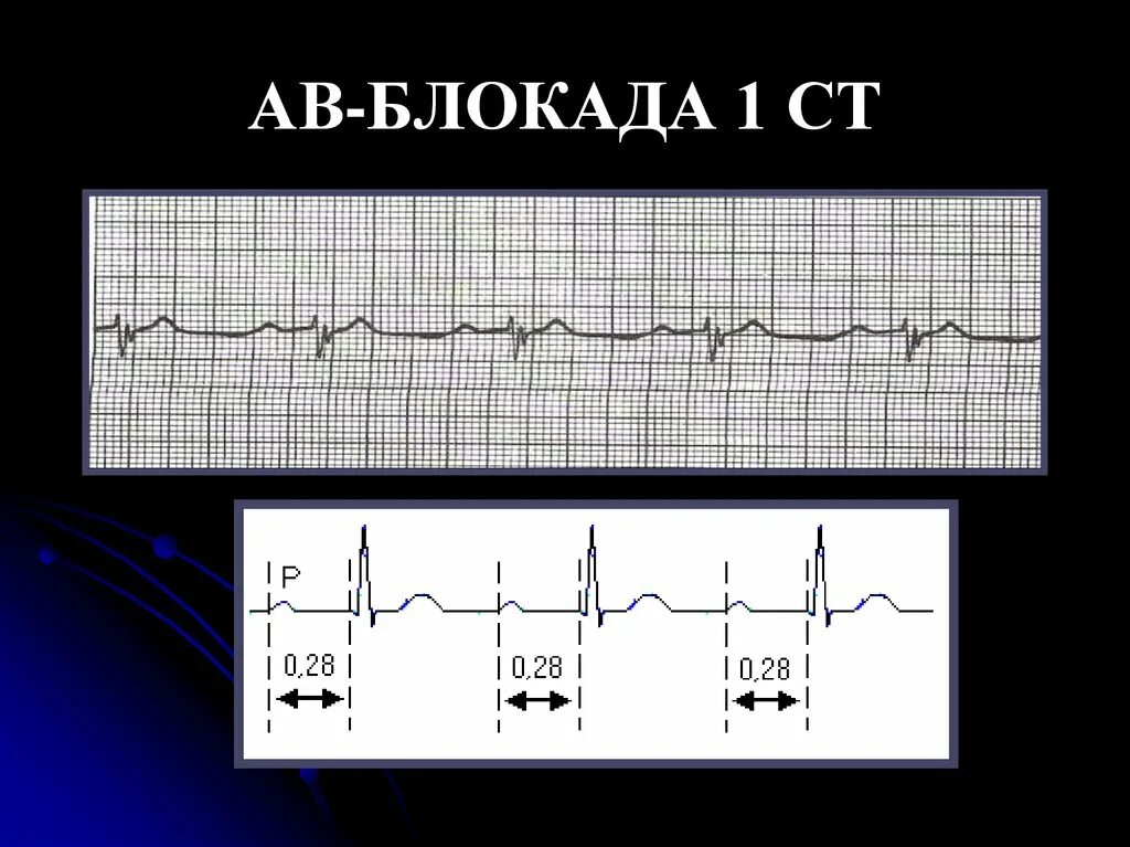 Блокада на первом. Аб блокада 1 степени на ЭКГ. Неполная АВ блокада 1 степени на ЭКГ. Транзиторная av блокада 1. Атриовентрикулярная блокада 1 ст.