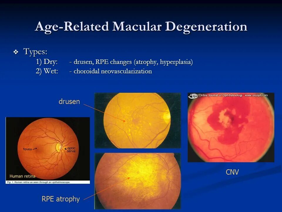 Age related Macular Degeneration Dry form.