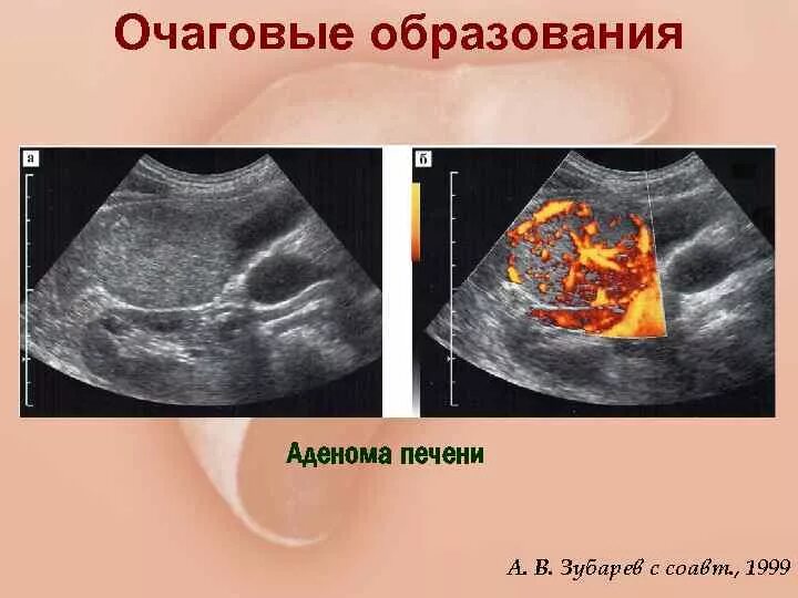 Округлое образование печени. Очаговое образование печени. Множественные образования печени. Множественные очаговые образования в печени.