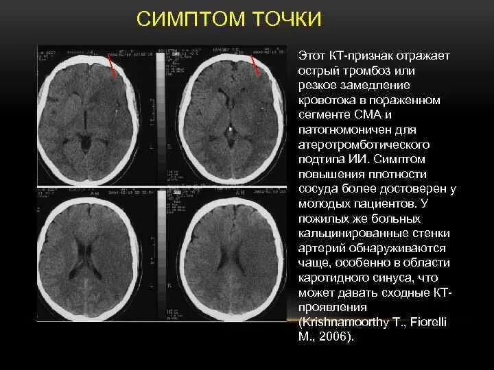 Тромбоз синусов головного мозга кт. Тромбоз венозного синуса головного мозга кт. ОНМК гиперденсивная артерия. Синусы головного мозга кт. Тромбоз мозговых сосудов