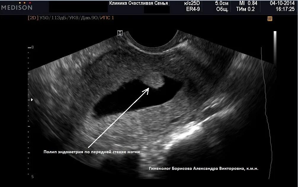 Эндометрий в полости матки. УЗИ картина полипа эндометрия. Плацентарный полип на УЗИ.