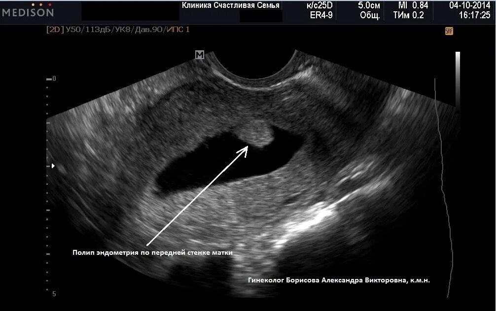 УЗИ картина полипа эндометрия. Плацентарный полип на УЗИ.