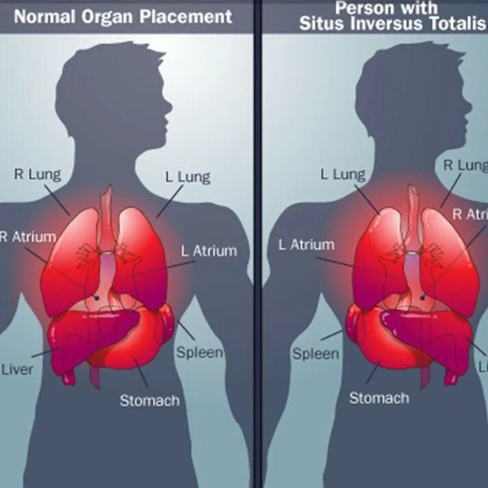 Человек который и правой и левой. Ситуа Инверсус тоталис. Зеркальное расположение органов. Зеркальное расположение внутренних органов у человека.