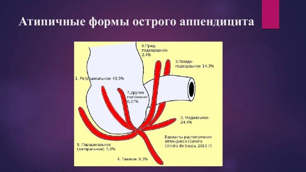 Локализация острого аппендицита. Атипичные формы аппендицита. Атипичная форма острого аппендицита. Атипичным формам острого аппендицита. Атипичные локализации острого аппендицита.