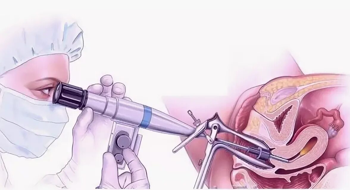 Биопсия выскабливанием. Полип эндометрия гистероскопия. Гистерорезектоскопия полипэктомия. Гистероскопия шейки матки. Санационная гистероскопия.