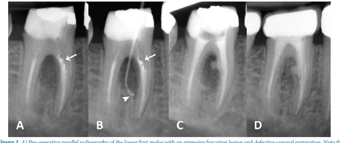 Перфорация корневого канала рентген. Перфорация стенки корневого канала. Перфорация шейки зуба рентген. Перфорация дна полости зуба рентген. Временное пломбирование корневых