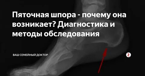Шпора по мкб 10 у взрослых