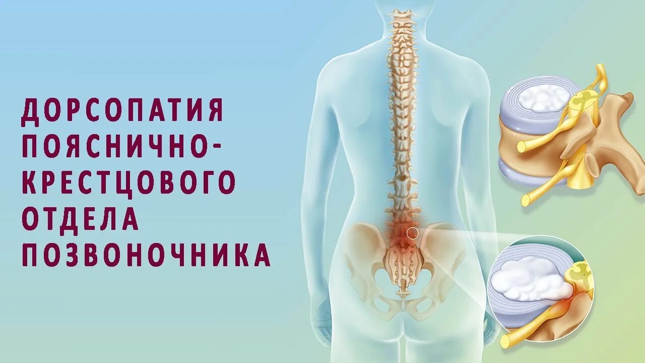 Дорсопатия пояснично крестцового отдела симптомы. Дорсопатия пояснично-крестцового отдела позвоночника. дорсопатии пояснично-крестцового отдела. дорсопатия поясничного отдела позвоночника. дорсопатии шейного отдела позвоночника.