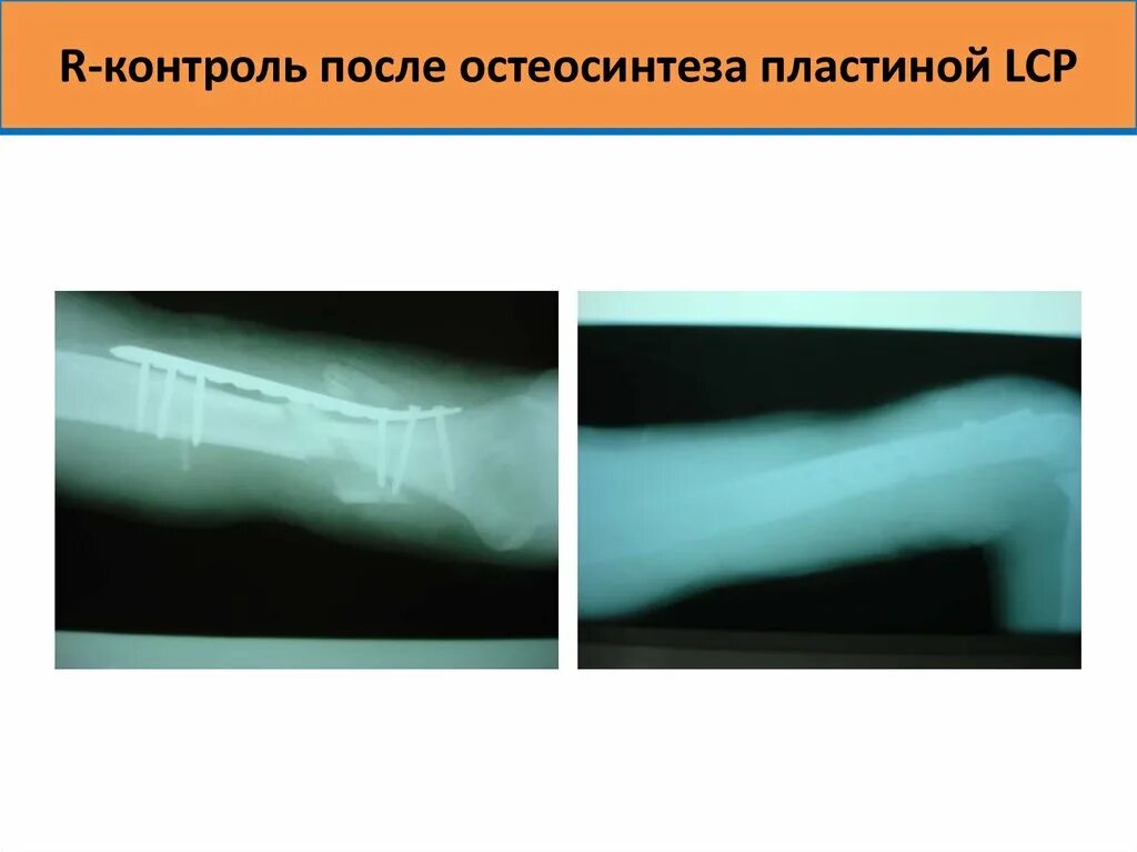 Здоровье перелом. Несрастание перелома после остеосинтеза. Несросшийся перелом ключицы. Ложный сустав после перелома ключицы. Пластина LCP остеосинтез ключицы.