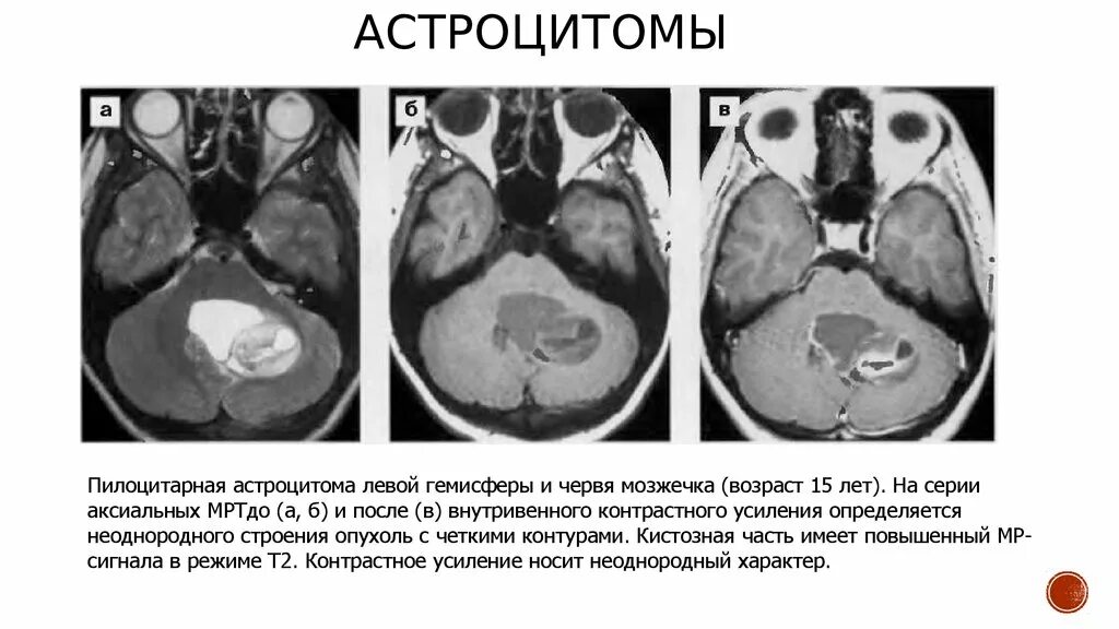 Пилоидная астроцитома. Пилоцитарная астроцитома. Пилоцитарная астроцитома мрт. Астроцитома мозжечка мрт. Кистозная астроцитома кт.