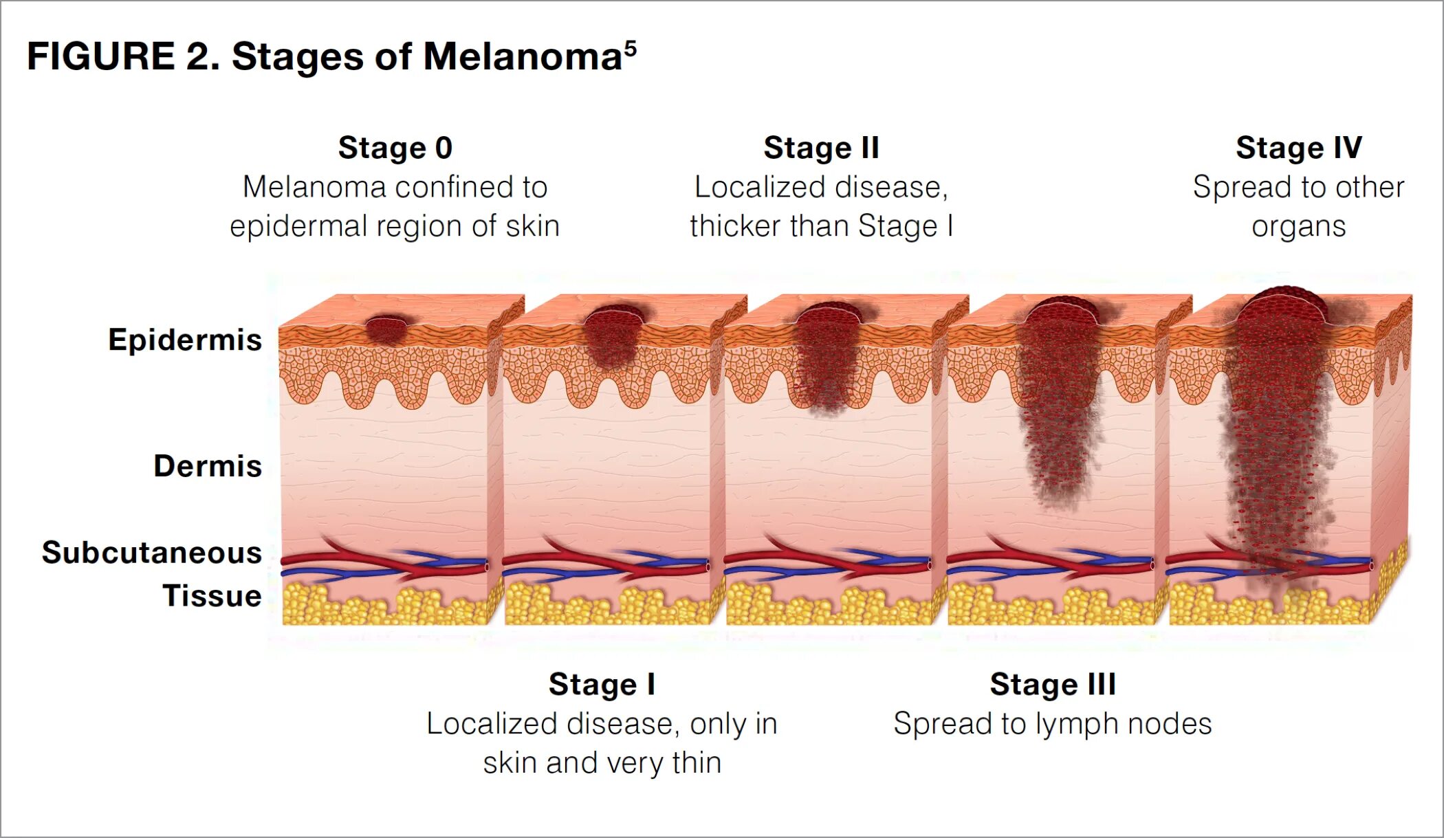 Десмопластическая меланома. Меланоцитарная меланома. Stages of cancer