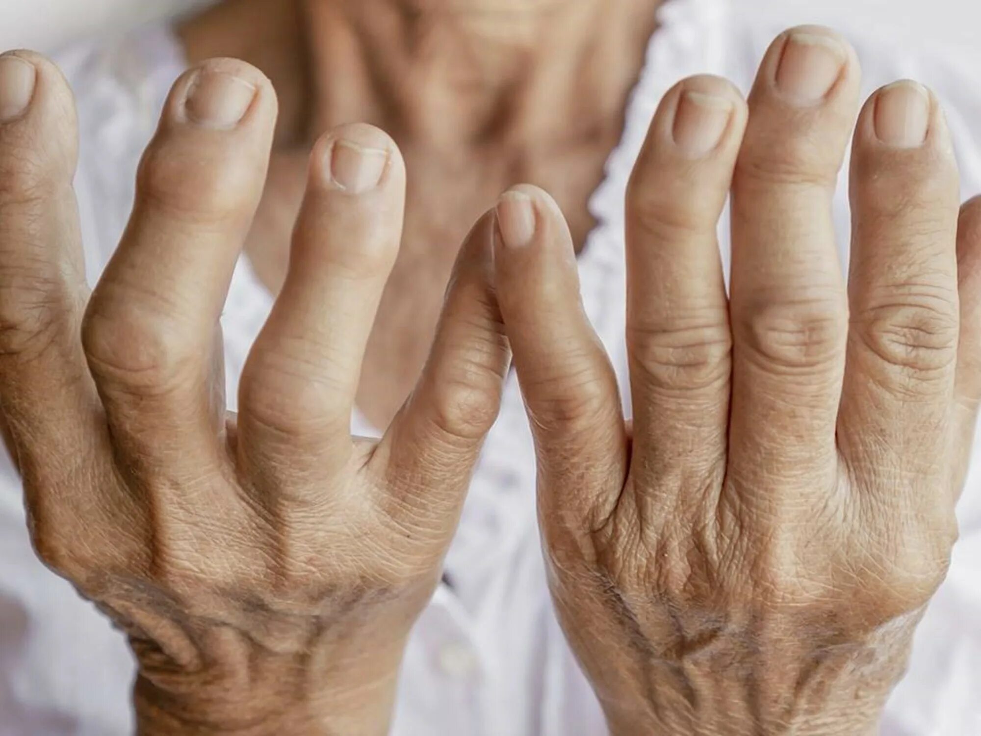 Ревматоидный артрит фото. Болят суставы пальцев рук к какому врачу