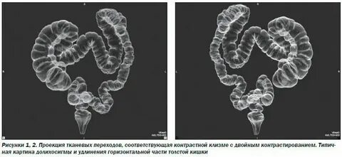 Долихоколон кишечника что это у взрослого лечение