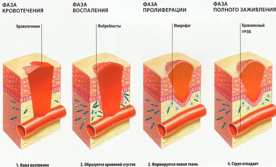 Воспаление ткани латынь. Заживления РАН грануляция. Фазы заживления ожоговых РАН. Кожа этапы заживления РАН. Грануляция тканей этапы заживления РАН.