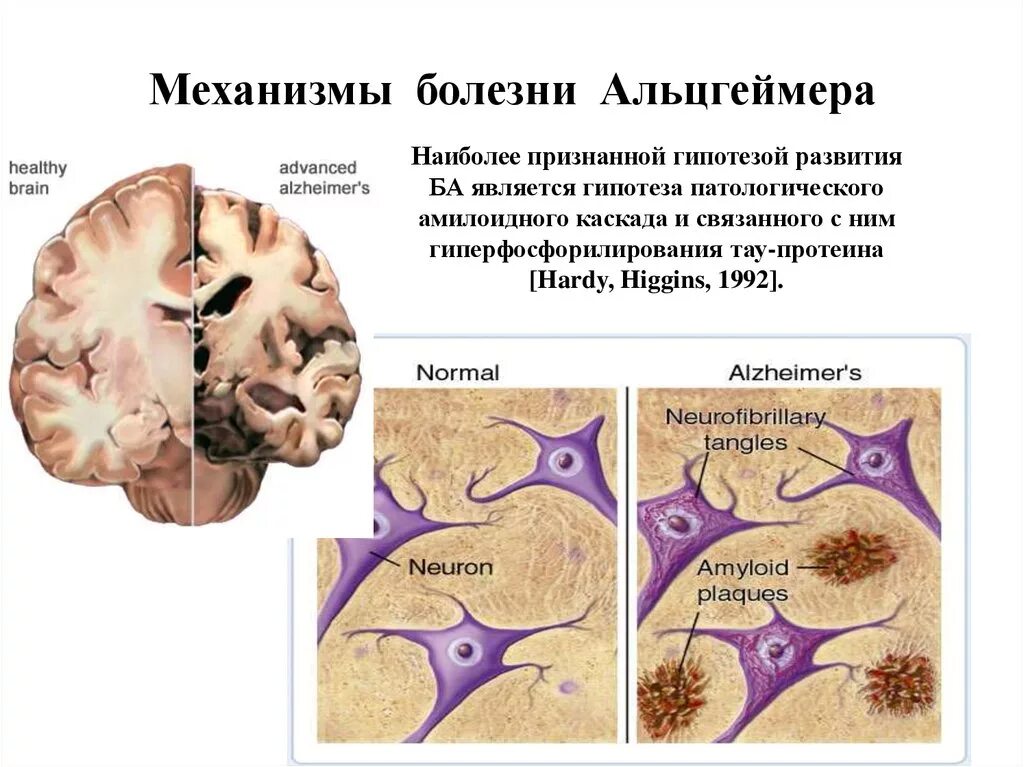 Механизм развития болезни Альцгеймера. Холинергическая теория болезни Альцгеймера. Болезнь Альцгеймера презентация. Амилоидная гипотеза болезни Альцгеймера.