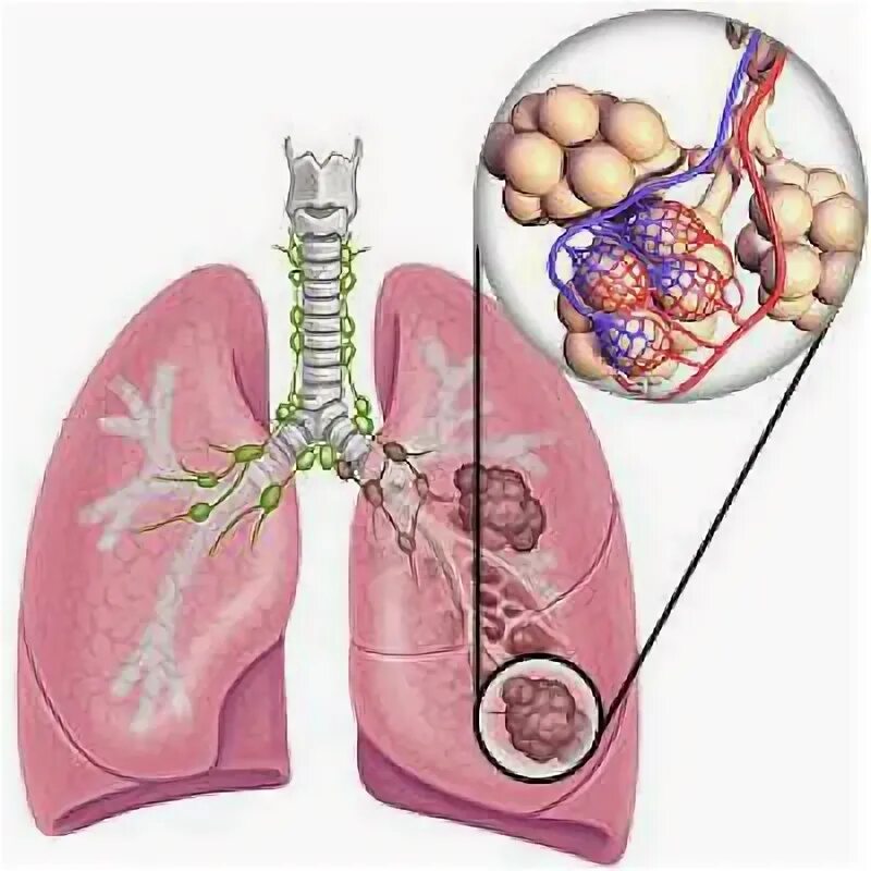 Спонтанный пневмоторакс. Удаление булл в легких. Эмфизематозные буллы рентген. Эмфизематозные буллы легких кт. Буллезная пневмония рентген.