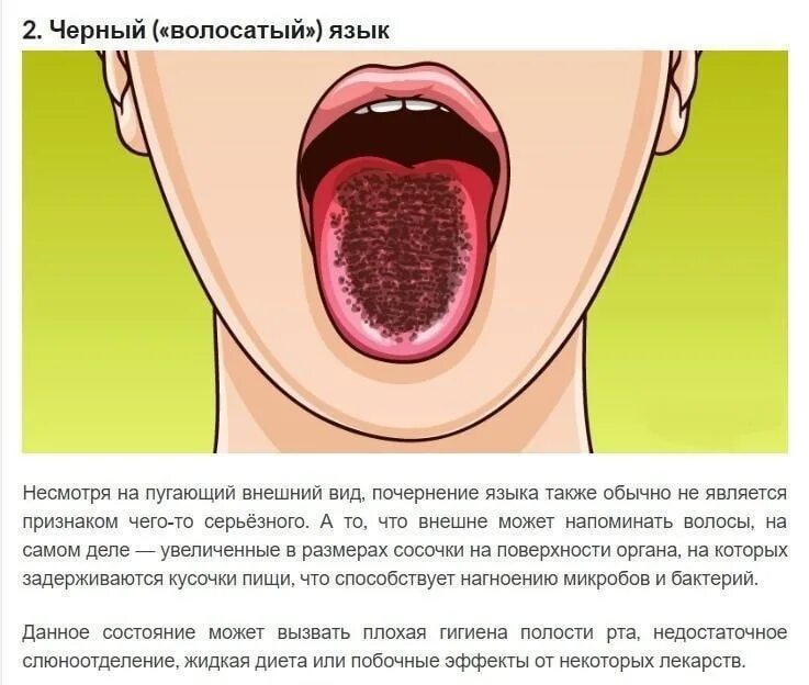 Какой язык при температуре. Распознавание болезни по языку. заболевания по цвету языка.