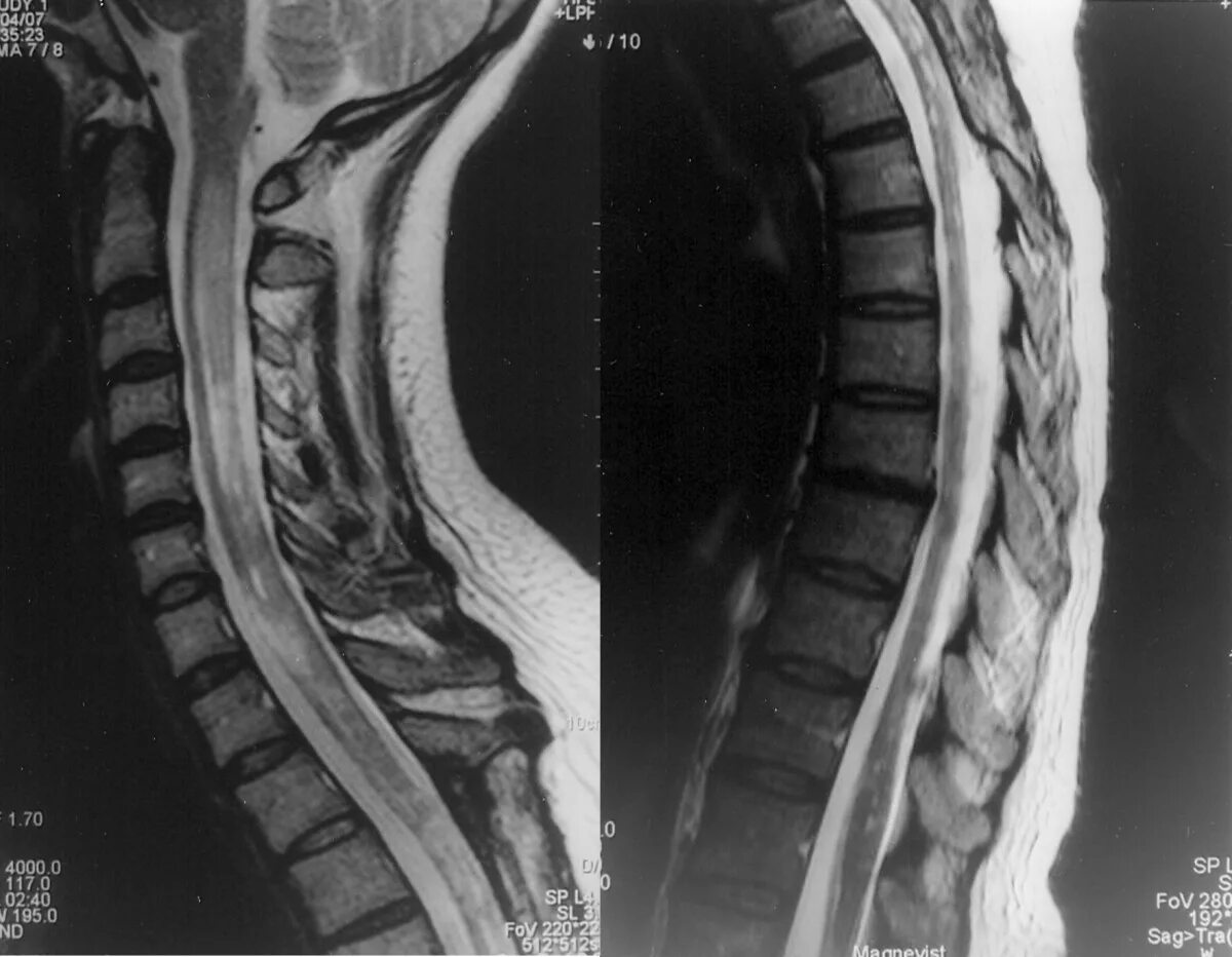 Spine mri