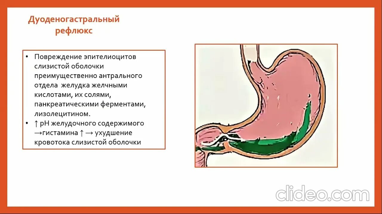 Антральный рефлюкс. Дуодено-гастральный рефлюкс. Доуденогастральный рефлюкс. Дуоденогастральный рефлюкс это. Слизистая антрального отдела желудка.