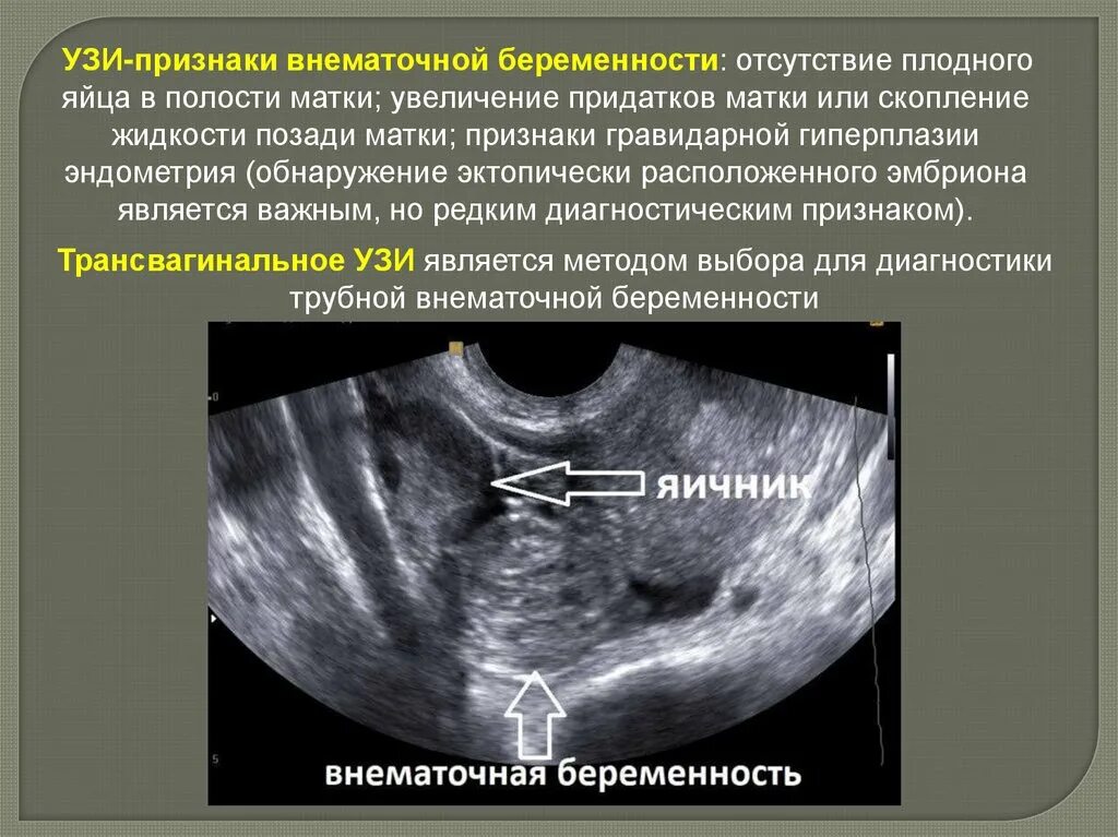 Как определить внематочную