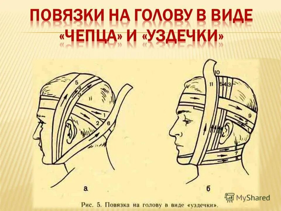 Как перевязывать голову. Повязка чепец и уздечка. Наложение повязки чепец. Чепец десмургия. Наложение повязки на голову в виде Чепца.