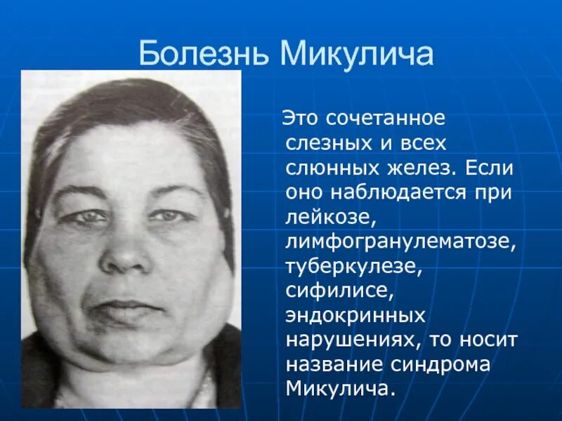 Синдром ля шапеля. Синдром шегрена, болезнь микулича. болезнь микулича и шегрена. болезнь слюнной железы шегрена. болезнь и синдром микулича.