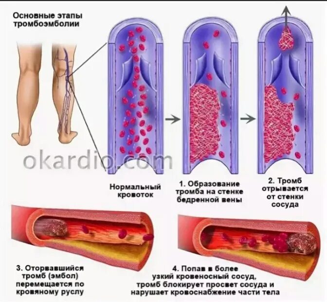 Тромбоз, тромбофлебит, тромбоэмболии. Эмболы в сосудах эмболия. Тромбоэмболия кровеносного сосуда. Тромбоз артерия и вена