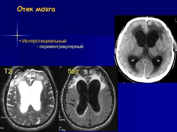 Уменьшение отека мозга. Перивентрикулярный лейкоареоз на кт. Перивентрикулярная лейкомаляция кт. Лейкоареоз и гидроцефалия. Перивентрикулярная лейкомаляция мрт.