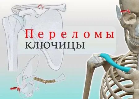 Перелом ключицы мкб