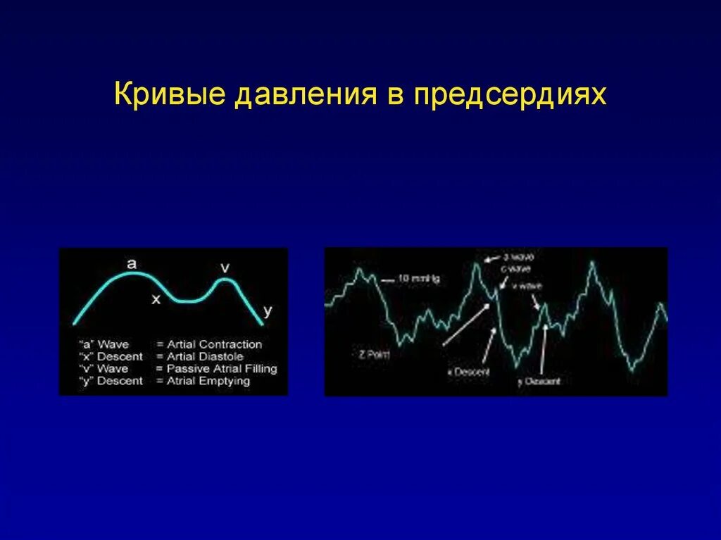 Давление в правом предсердии. Кривые давления в предсердиях. Кривая давления в правом предсердии. Кривая давления ад. Кривая давления правого предсердия.