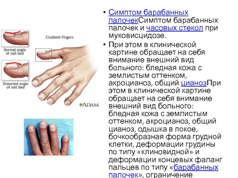 Симптом часовых. Патогенез формирования барабанных палочек. муковисцидоз симптом барабанных палочек. барабанные палочки симптом муковисцидоза. симптом барабанных палочек и часовых стекол.