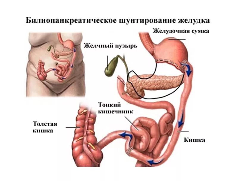 Бариатрическая операция спб. Желудочное шунтирование операция. Шунтирование желудка схема операции. Бариатрическая операция гастрошунтирование. Бариатрические операции шунтирование желудка.