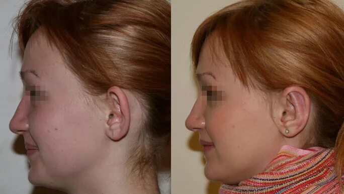 Пластика лица. Otoplasty surgery. Пластическая операция уха. Пластическая операция уха. Пластическая хирургия ушей.