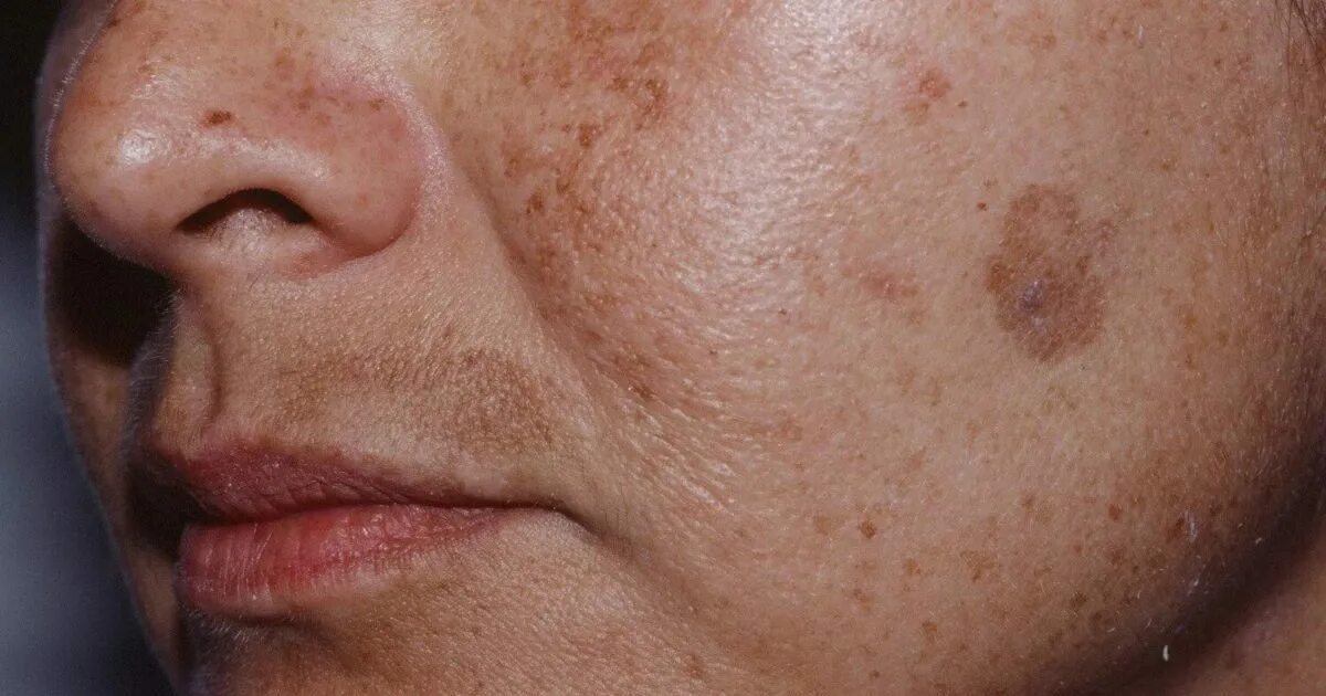 Как вылечить пятна на лице. Папулопустулезной розацеа. Как вылечить пятна на лице. Как вылечить пятна на лице. Веснушки, лентиго, мелазма.