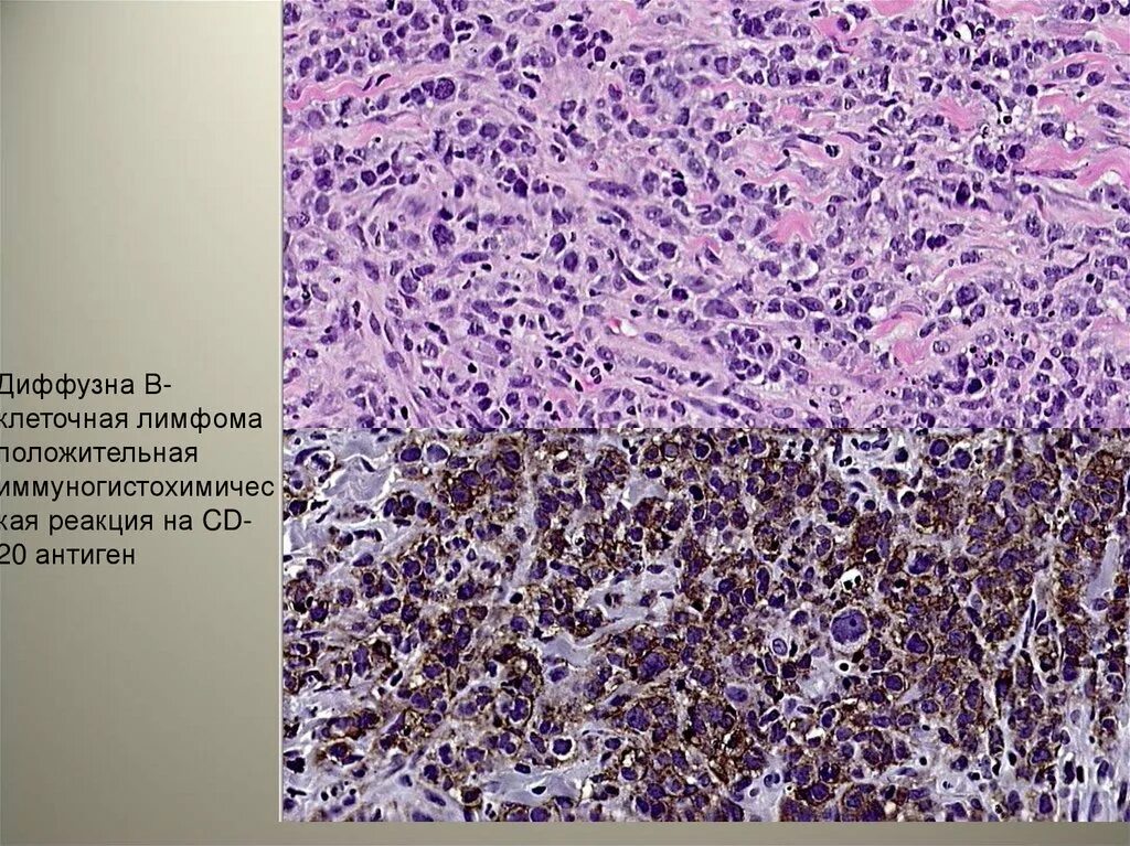 Крупноклеточная лимфома гистология. Крупноклеточная неходжкинская лимфома гистология. Лимфома Ходжкина гистология. Диффузная крупноклеточная в-клеточная лимфома. Диффузная реакция