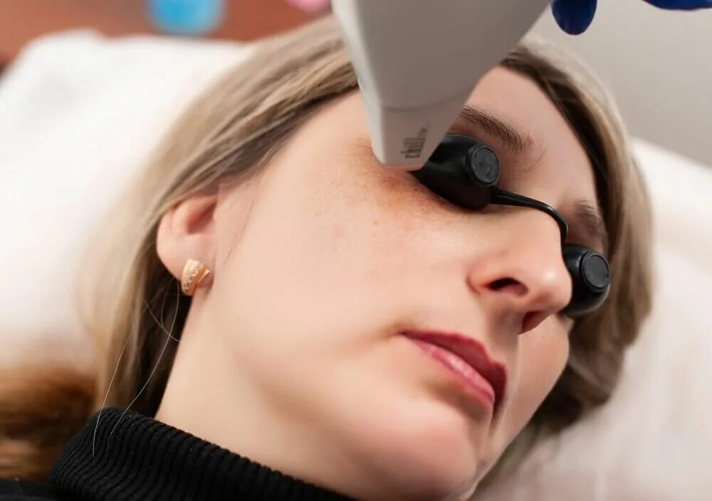 Лазерный пигмент. Лазерный пигмент. Удаление пигментации лазером. Пигментация после лазера. Lumenis m22.