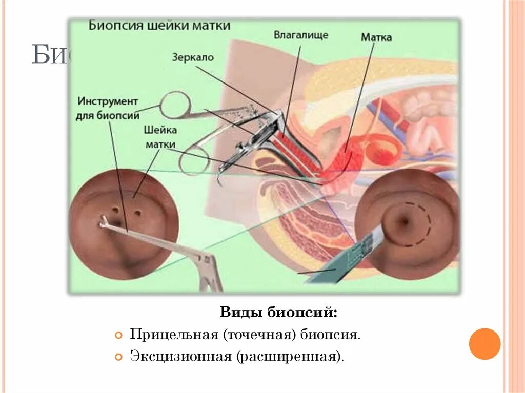 Как берут биопсию шейки. Эксцизионная биопсия шейки матки методика. эксцизионная биопсия шейки матки петлевая. эксцизионная биопсия шейки техника. кольпоскопия с биопсией шейки матки.