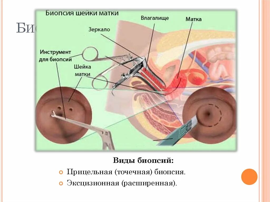 Эксцизионная биопсия шейки матки методика. Эксцизионная биопсия шейки матки петлевая. Эксцизионная биопсия шейки техника. Кольпоскопия с биопсией шейки матки.