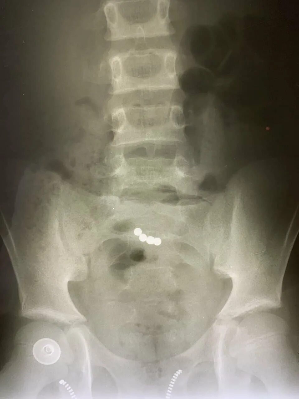 Пластмассовые инородные тела. Дети глотают магнитные шарики. Ребенок проглотил конструктор. Ребенок проглотил деталь лего. Ребенок проглотил магнитные шарики.