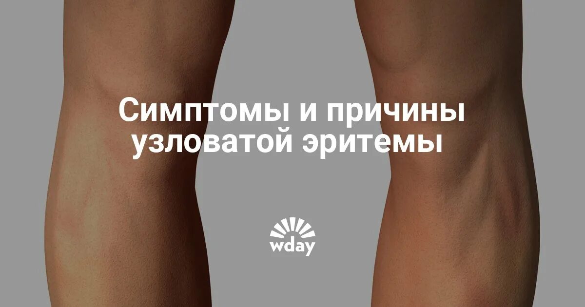 Узловатая эритема на ногах как выглядит Саркоидоз презентация онлайн