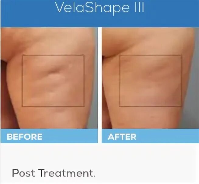 Вела Шейп Результаты до и после. Vela Shape 3 отзывы фото до и после.