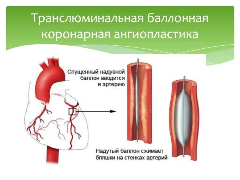 Баллонная коронарная ангиопластика. Чрескожная баллонная ангиопластика. ТРАНСЛЮМИНАЛЬНАЯ баллонная ангиопластика легочных артерий. Коронарно пнгиопоастика поепзание. Баллонная ангиопластика коронарных артерий без стентирования.